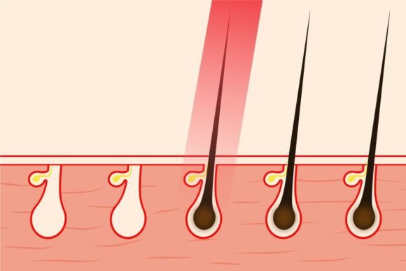 Download Hair Removal with Laser Light Vector - Light Collection